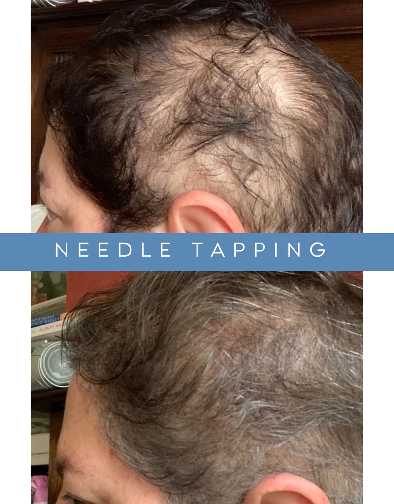 https://sereniteskin.com/cdn/shop/files/needale2_1024x1024.png?v=1722860835